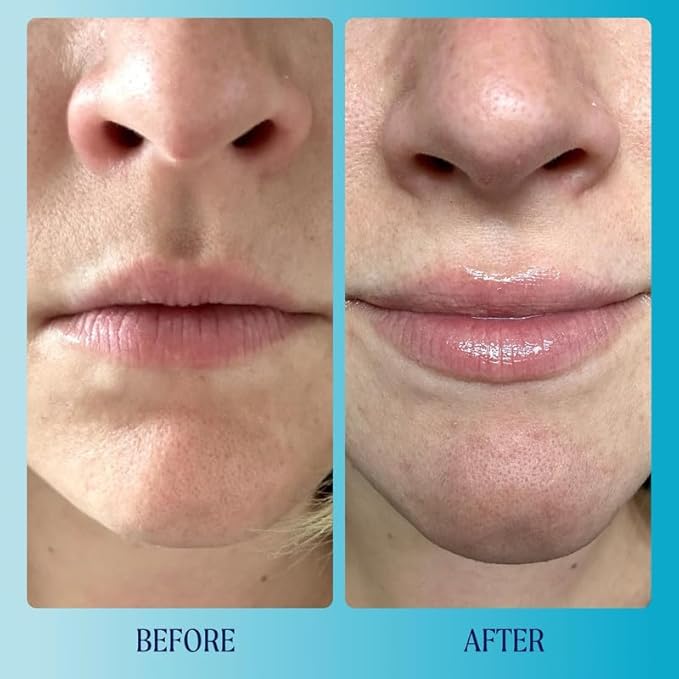 Kinship Supermelt Lip Plumping Jelly Mask - Moisturizing Daily Lip Treatment + Hyaluronic Acid - Hydrating + Exfoliating Lip Gloss - Soft, Smooth, Plump - Quick Melting Balm - Soothe Dry Lips (.3 oz)