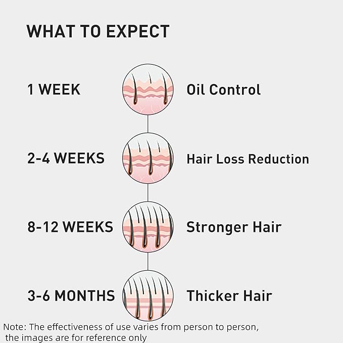 0.5% KINTOR KX-826 Hair Growth Spray,Oil Control Strengthen Hair,Hair Regrowth Products for Women&Men,Basic,360ml