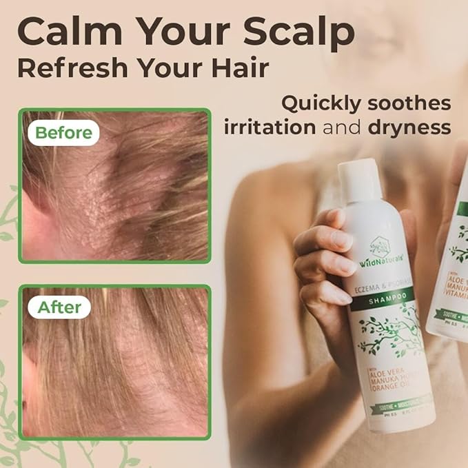 Eczema & Psoriasis Treatment Shampoo - Anti-Dandruff, Scalp Relief for Dry & Itchy Skin - Hypoallergenic, Paraben & Fragrance-Free for Sensitive Scalp