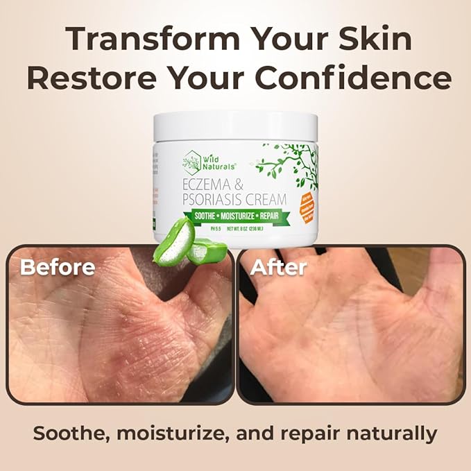Wild Naturals Eczema & Psoriasis Cream for Dry, Itchy Skin – Eczema Relief for Adults & Kids – Moisturizing Psoriasis Cream with Manuka Honey - Hydrating Honey Lotion for Hands and Face