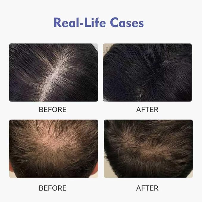 0.9% KX-826 KINTOR Hair Growth Products Foam, DHT Blocker for Men & Women Hair Regrowth, 180ml Pro