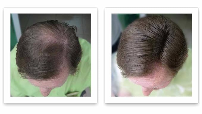 Hair Building Fiber. Cover Bald Spot and Thinning Hair Instantly. 10X Fuller Hair. All-Natural, Organic Hair Loss Concealer. Trial Size (10-Day Supply). Medium Brown