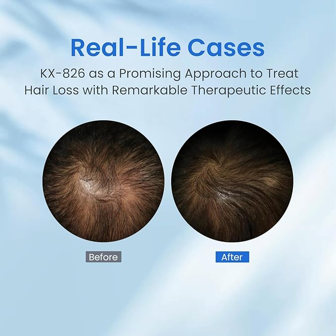 0.5% KX-826 Hair Growth Spray DHT Blocker Hair Thickening Regrowth Treatments,Oil Control Hair Loss Reduction 3-6 Months New Hair Visible,Hair Growth Products Men&Women-1 Month Supply 60ml
