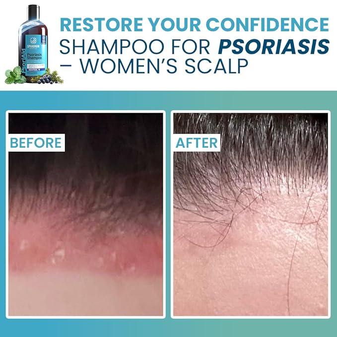 Sphagnum Botanicals Psoriasis Shampoo with Salicylic Acid - Natural Scalp Treatment for Dry, Itchy, Flaky Scalp with Menthol & Peat Mud – Sulfate-Free, Gentle Formula – 13.5 fl oz