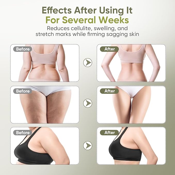 Body Sculpting Machine — Lymphatic Drainage Massager & Anti Cellulite Massage Tool, for Legs, Arms & Belly, Body,Helps Reduce Stretch Marks & Cellulite,with Microcurrent, Light Heat & Vibration
