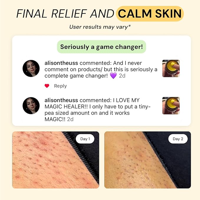 MyMagicHealer Thyme & Tea Tree Flare Care | Ingrown Hair, Razor Bumps, Blind Pimples, Bartholin, Pilonidal Cysts | Folliculitis Cure | Piercing Care w/Egg Yolk Extract & Tea Tree 4 oz