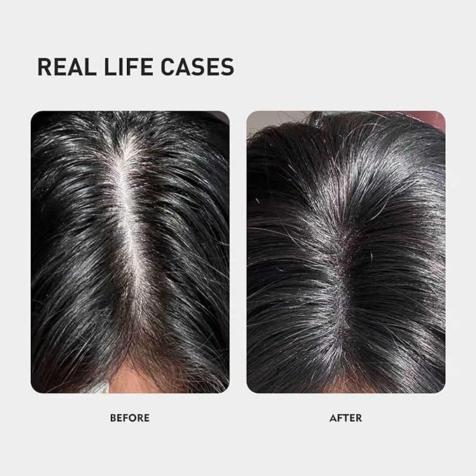 0.9% KX-826 KINTOR Hair Growth Products Foam, DHT Blocker for Men & Women Hair Regrowth, 360ml Pro