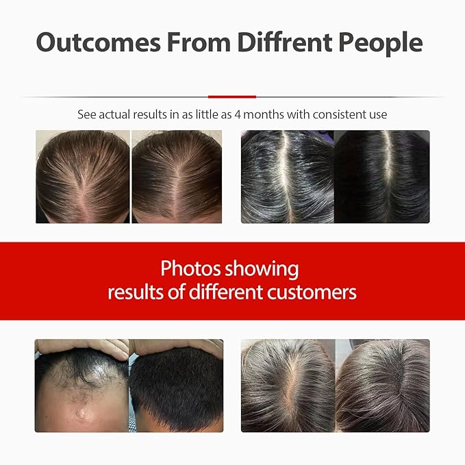 Laser Cap, Portable Red Light Therapy for Hair Growth, Hair Loss Treatments Hat for Men & Women, with Built-in Battery & Controller