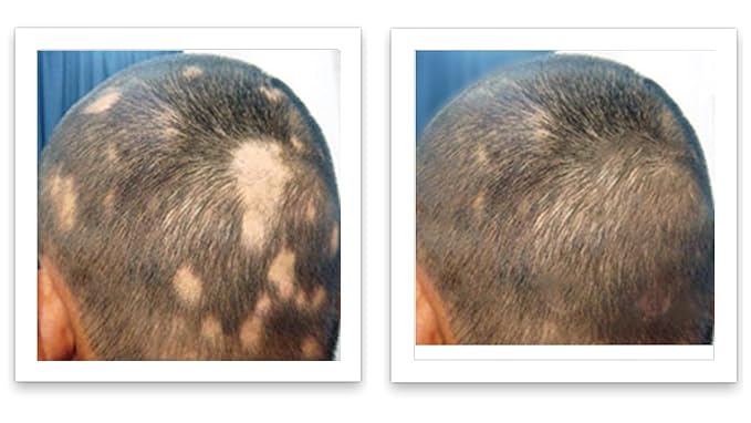 Caboki 10X Hair Volumizer for Thinning Hair: Root Touch Up, Fill in Hairline & Edges, Cover Bald Spots and Gray. TALC-Free, Healthful Powder for Men and Women. Light Auburn