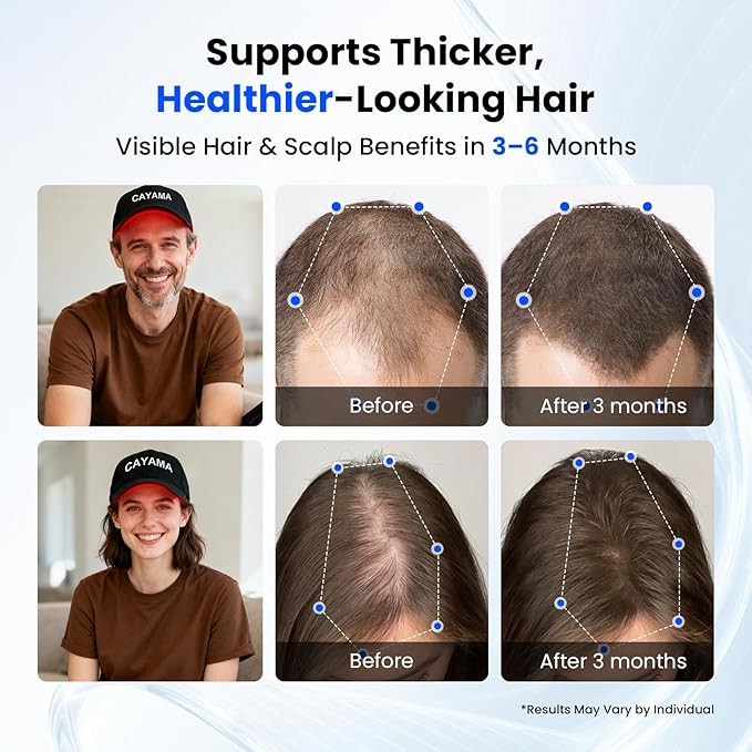 Red Light Hair Growth Cap, Red Light Therapy for Hair Growth, 528 LEDs, 4 Modes & 3 Levels, Portable Rechargeable Hair Care Cap with 5000mAh Remote for Men & Women