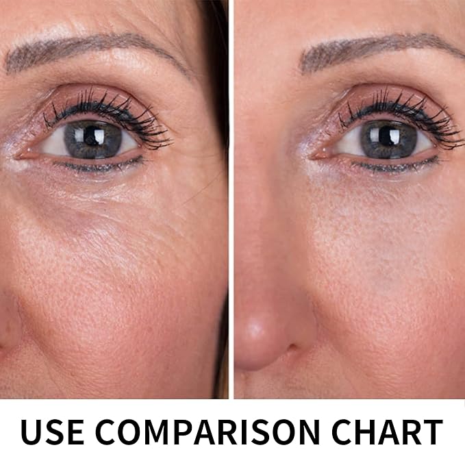 Pdo Threads Lift for Eyes, Pdo Lifting Thread, Improves Wrinkles And Sagging Around The Eye Area (20PCS-30G*38MM)