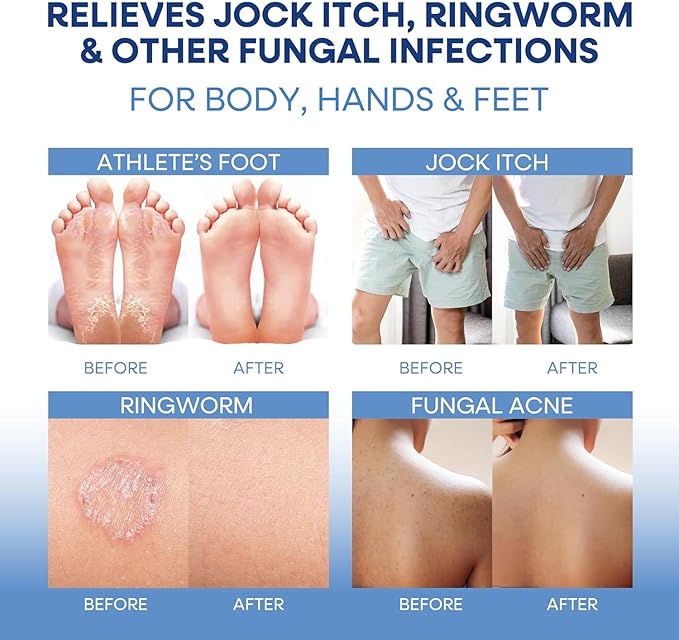 Hermon Jock Itch Antifungal Treatment Kit: Relief for Ringworm, Athlete’s Foot, Tinea Versicolor - Body & Foot Fungus Care Set for Men & Women 100g Cream + 2 Bar Soap