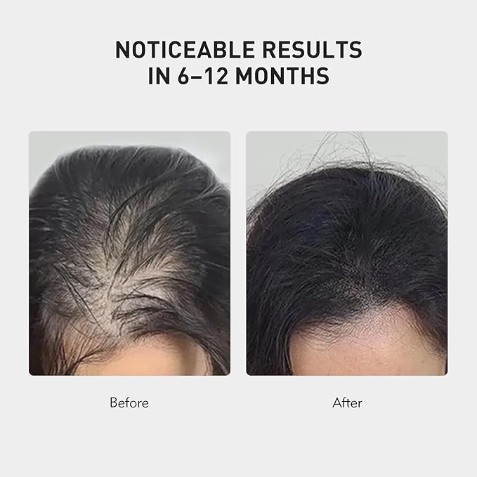 0.9% KX-826 KINTOR Hair Growth Spray,Strengthen Hair Nourish Hair follicles,Hair Care Products for Sparse Hair and Oily Hair Men&Women,60ml,Pro