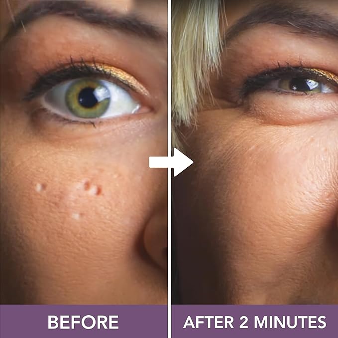 Dermaflage Scar Filler Kit - Deep - Deep Scar Cover and Waterproof Concealer for Acne Scars Wrinkles, and Ice Pick Scars Makeup, 1 mo supply