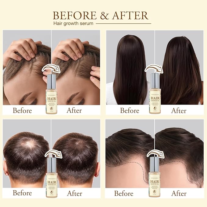 Hair Growth Oil with Rosemary & Biotin: Natural Hair Regrowth Serum for Women & Men – Anti Hair Loss & Thinning Treatment – Promotes Thicker, Fuller, Stronger, Healthier Hair – All Hair Types