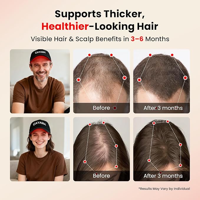 CAYAMA Red Light Therapy Cap, Laser Hair Growth Cap Red Light Therapy for Hair Growth – 528-LEDs