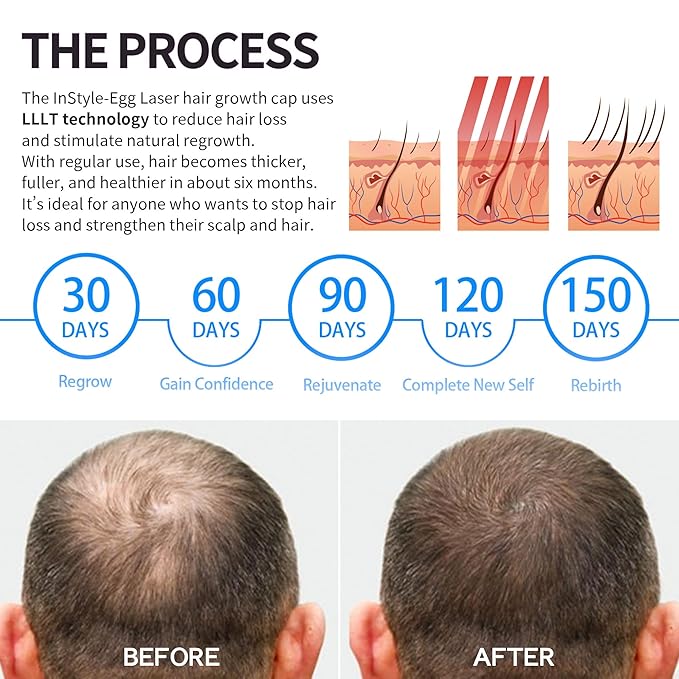 Instyle Egg Laser Cap 272 for Hair Growth, Hair Regrowth System for Men/Women, Scalp Treatment to Stop Hair Loss and Regrows Thinning Hair, laser hair regrowth