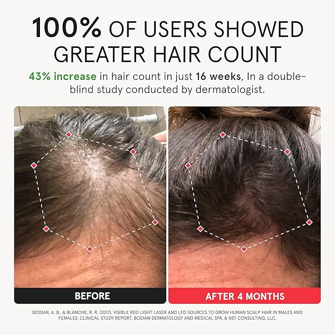 iRestore Elite - Laser Red Light Therapy for Hair Growth System - FDA Cleared Hair Loss, Hair Thinning & Alopecia Treatment for Men & Women - Laser Cap for Hair Regrowth Stimulates Denser Fuller Hair