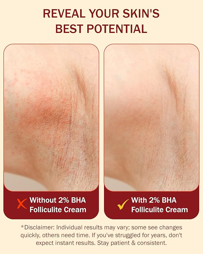 Folliculitis Cream – Folliculitis Treatment for Red Bumps, Ingrown Hairs & Razor Irritation – 2% BHA, Tea Tree, Salicylic Acid, Turmeric & Aloe – Scalp Acne treatment (4 oz)