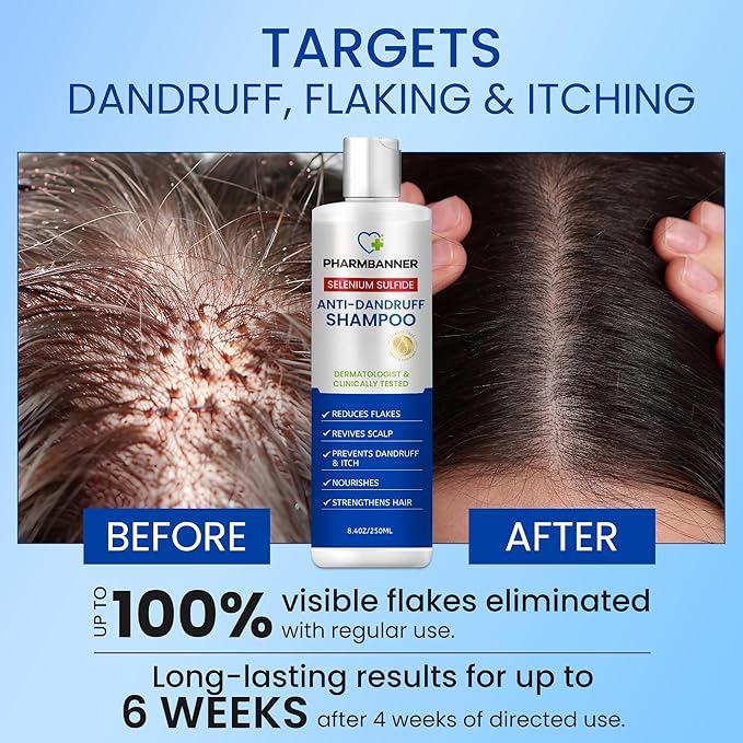 Anti-Dandruff Shampoo with Selenium Sulfide – Medicated Anti-Fungal Formula for Seborrheic Dermatitis & Folliculitis – Itchy, Flaky & Oily Scalp Relief – Menthol & Lavender Oil