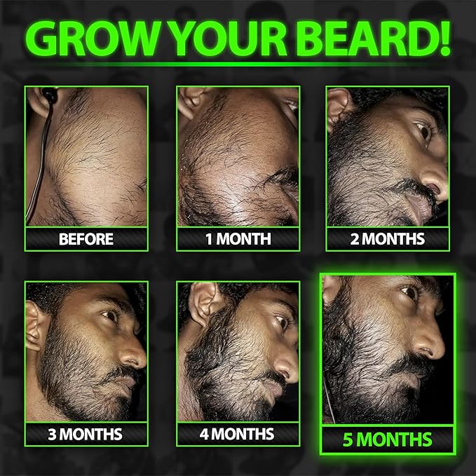 Beard Growth Oil with Facial Derma Roller (2-Pack Hair Follicle Stimulators) – 540 Titanium Rollers for All Skin Types – Fills Patches, Boosts Growth, Thickens Beard for Fuller Facial Hair