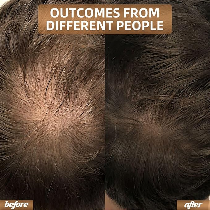 Red Light Therapy for Hair Growth, Quick-Release Panels & Portable Design, Laser Hair Growth Cap, Hair Loss Treatments Hat