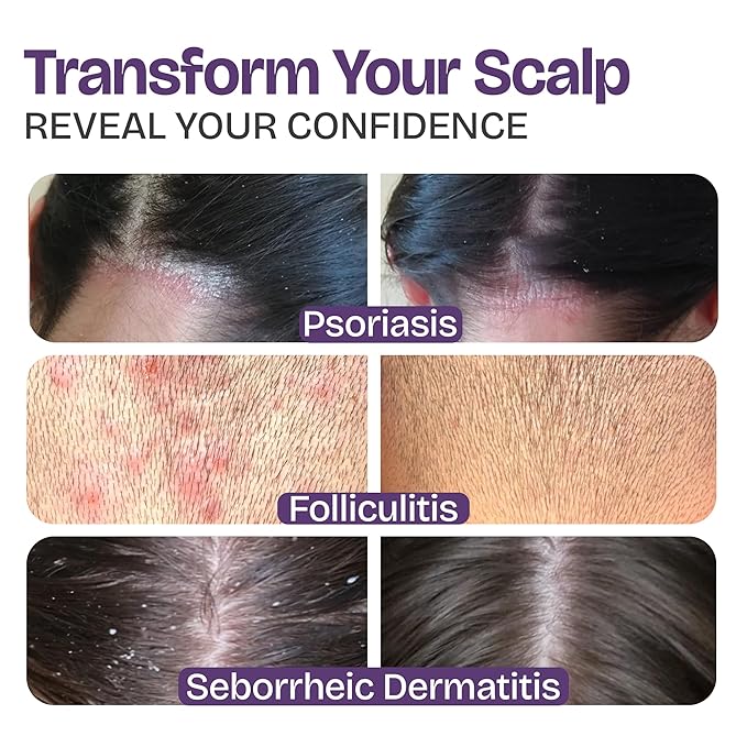 Psoriasis Shampoo for Eczema, and Folliculitis Treatment - Seborrheic Dermatitis Antifungal Shampoo for Ringworm, Acne, Flaking, Dry & Itchy Scalp Treatment - Psoriasis Relief with Manuka Honey