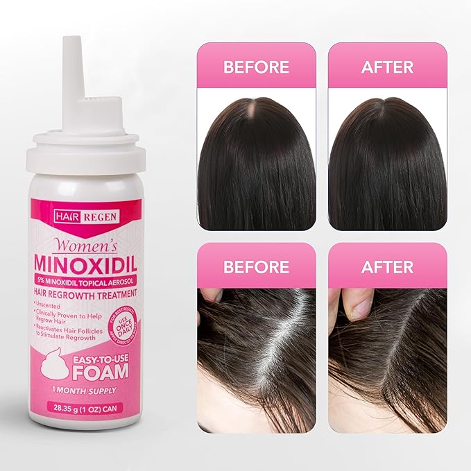 Minoxidil Foam for Women 5% Percent - Women's Hair Growth Treatment for Her - Topical Foaming Minoxidil for Women - Great for Hair Regrowth and Reduce Hair Loss - 1 Pack as 1 Month Supply