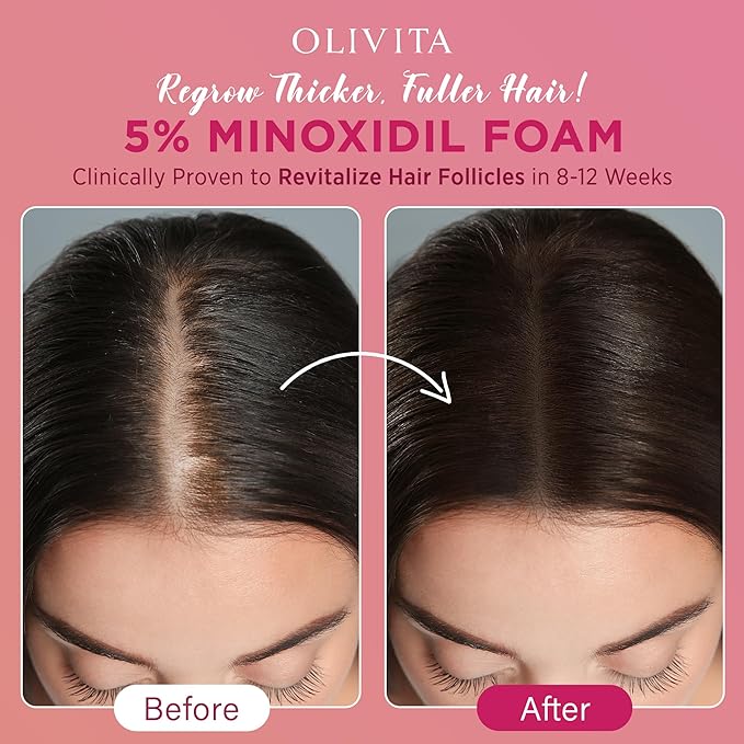 5% Minoxidil Foam for Women Hair Growth: Extra Strength Hair Regrowth Treatment – Revitalize Hair Follicles & Regrow Thicker, Fuller Hair – Hair Loss Solution - 2x60ML