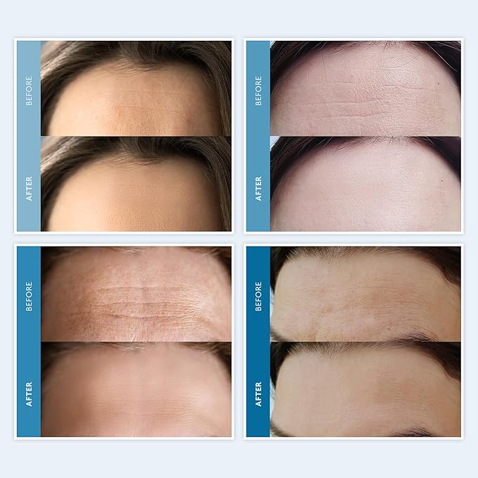 Dersie Silicone Forehead Wrinkle Patches: Reusable Anti Wrinkle Pads for Wrinkles - Overnight Use Forehead Wrinkles Treatment (3 Count (Pack of 1))