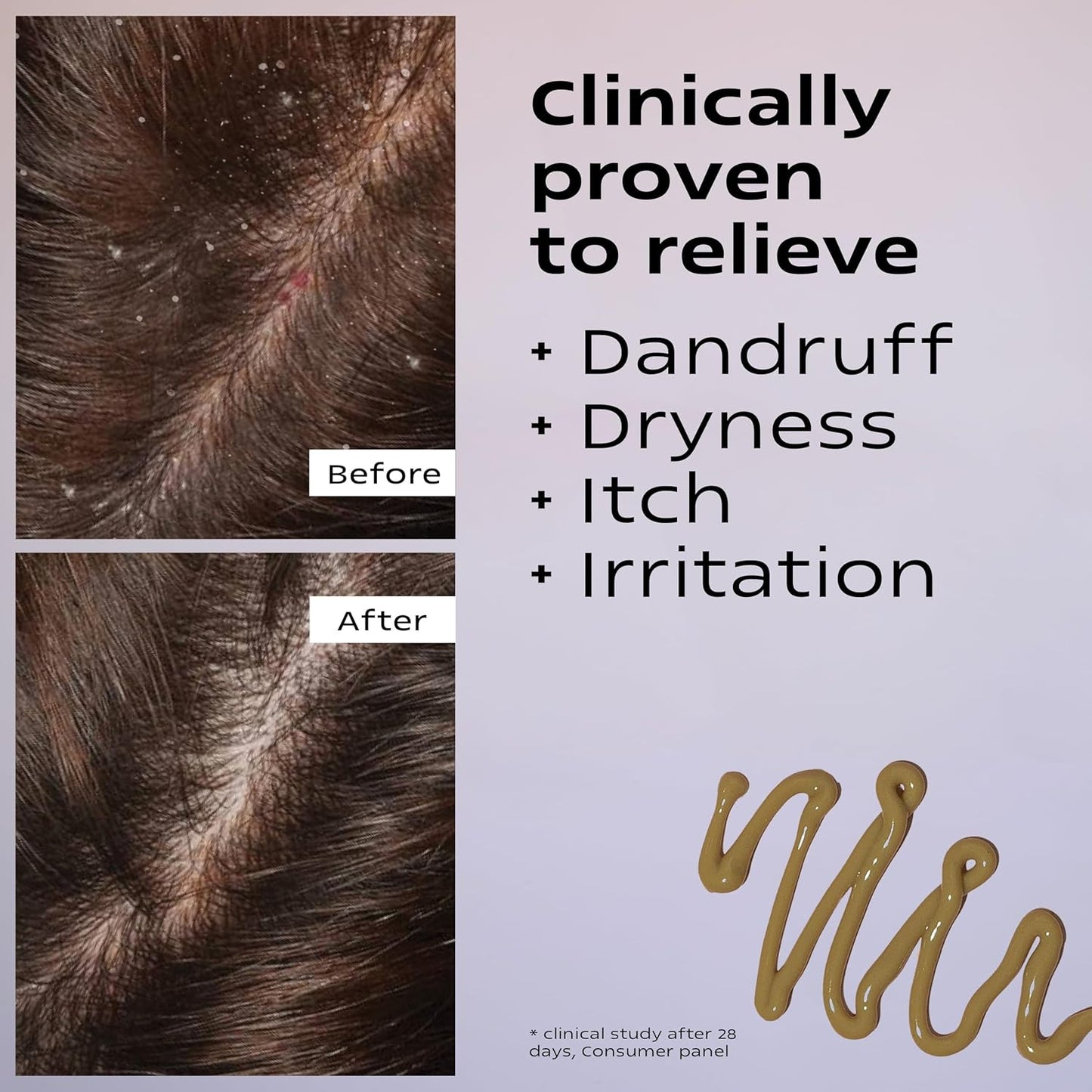 KAMEDIS Scalp Moisturizer Lotion For Dry, Itchy, Dandruff, Flaky, Seborrheic Dermatitis, Psoriasis and Sensitive Scalp. Over-Night Mask Treatment Botanicals-Based. Parabens Free. 3.38 Fl Oz.