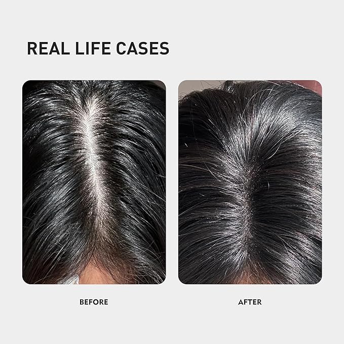 0.5% KINTOR KX-826 Hair Growth Spray,Oil Control Strengthen Hair,Hair Regrowth Products for Women&Men,Basic,300ml