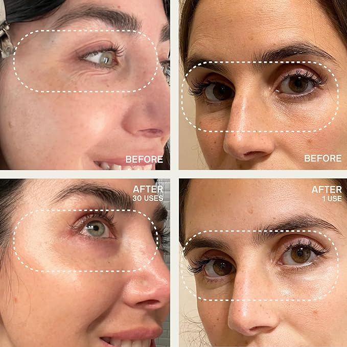 Dermaclara Silicone Facial Patches - Anti-Wrinkle Face Patches for Frown, Smile Lines & Forehead, Reusable Overnight Silicone Wrinkle Pads, Up to 30 Uses - 4 Under Eye Patches & 1 Forehead Patch