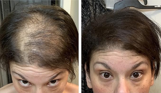 Hair Loss Concealer. Cover Bald Spot and Thinning Hair Instantly. Make Thin Hair Look 10X Fuller. All-Natural Hair Building Fiber. Trial Size (10-Day Supply). Dark Brown