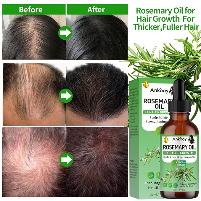 2 Pack Rosemary Oil for Hair Growth,Rosemary Hair Growth Oil,Hair Strengthening Serum for Dry Damaged Hair,Hair Loss Treatment & Thickens Hair,Scalp Care Promotes Hair Thickness for Men Women