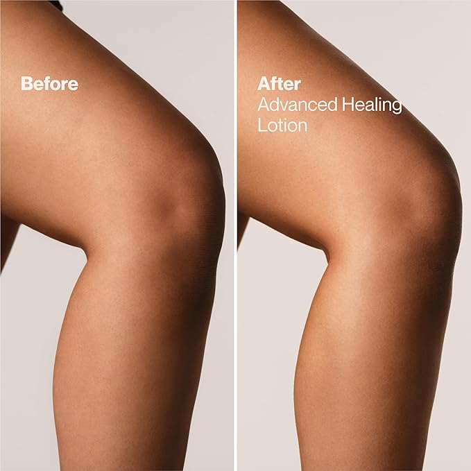 Suave+ Advanced Healing Hand & Body Lotion for Women With Ceramides for Very Dry Skin, Hydrating, Non-Greasy, Allergen-Free Moisturizing Cream, Lightly Scented, 18 FL OZ, 6 Pack