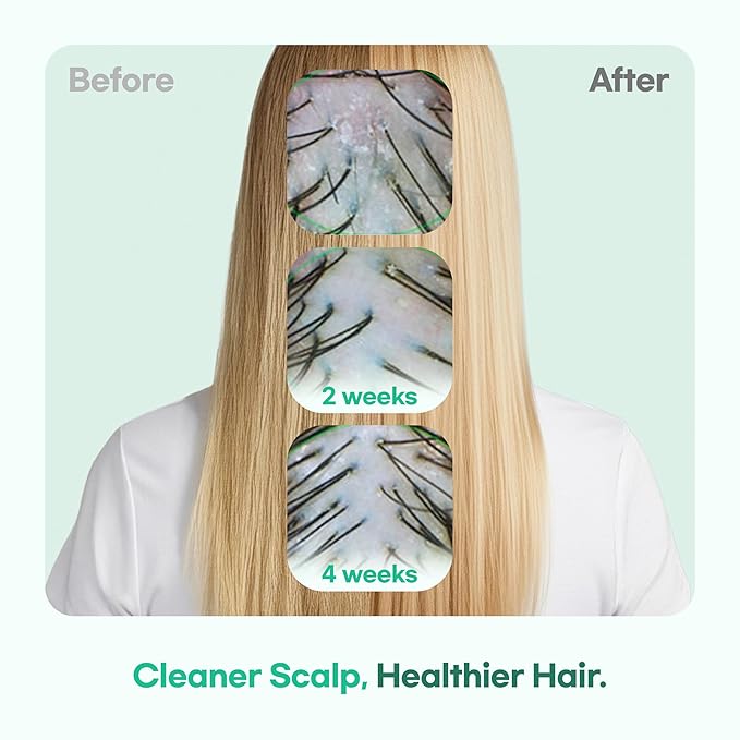 TS GD Shampoo for Teens | Korean Anti-Dandruff Shampoo for Oily & Itchy Scalp | Fruity Allergy-Free Scent | Sulfate-Free Gentle Hair Care (14.1 Oz)