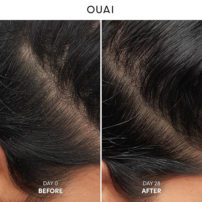 OUAI Detox Shampoo (10 fl oz) & Anti-Dandruff Deluxe Size (1 fl oz) Bundle - Soothing, Clarifying Shampoo Set for Dry, Flaky Scalp - Removes Dirt & Build Up (2 Count)