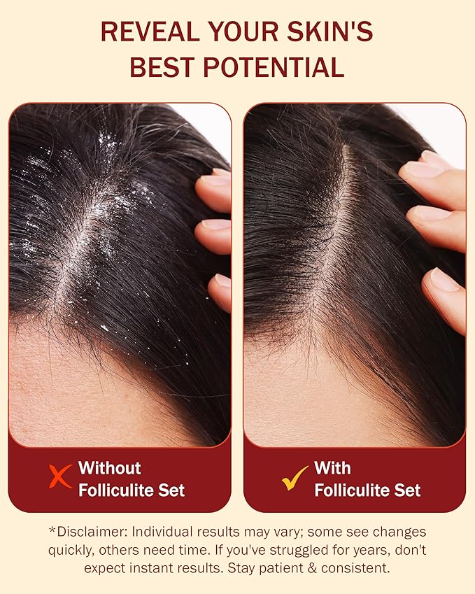Folliculitis Treatment Shampoo with 3% BHA, Salicylic Acid, Tea Tree Oil & Chamomile Extracts - Anti Itch Shampoo for women & men with Irritated Flaky Scalp Treatment, Made in USA by e70, 8 fl oz