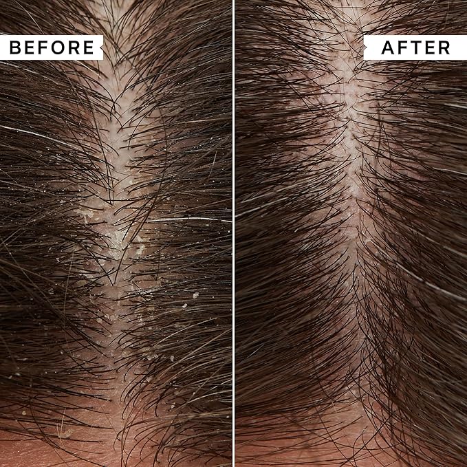 PHILIP KINGSLEY | Flaky Scalp Shampoo | Shampoo For Flaky, Itchy, Dry, Oily Scalps | Cleansing Scalp Care | Hair Shampoo that Hydrates, Soothes and Calms | 1L Pump